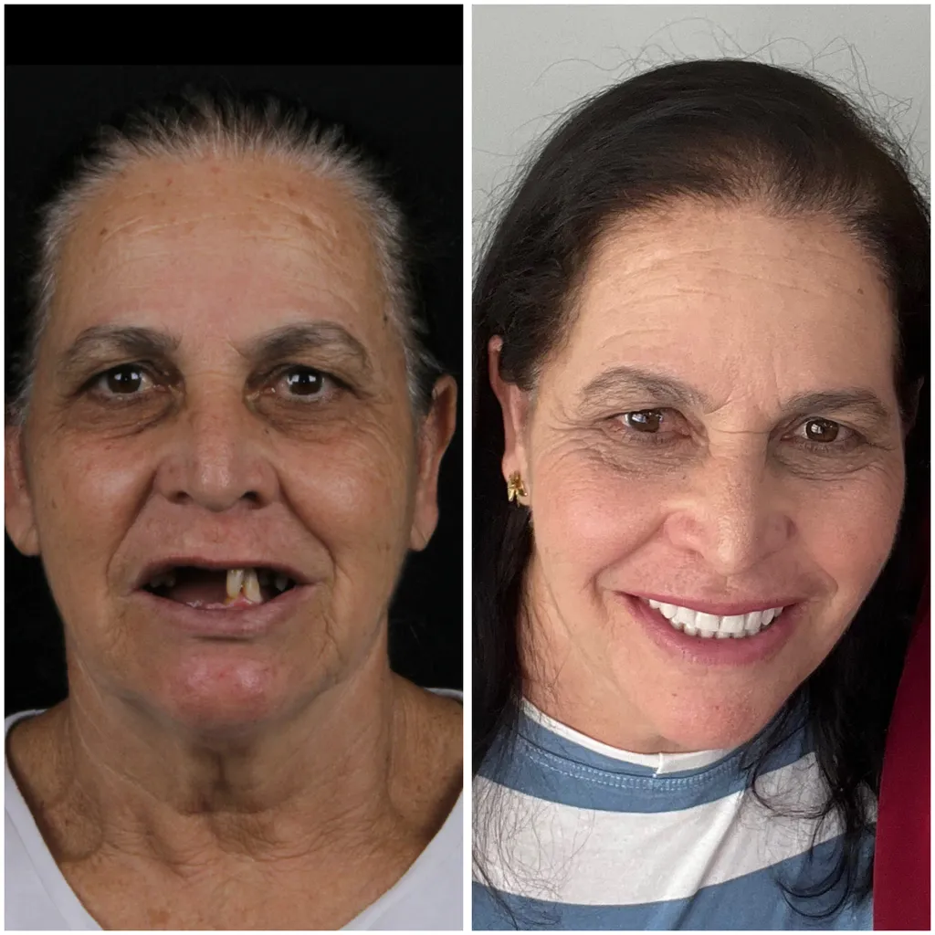 Antes e depois, resultado clínico após tratamento com implantes e protocolo dentário